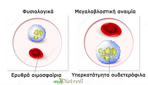 megalovlastiki-anaimia-ti-einai