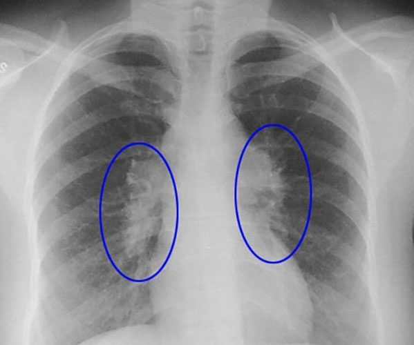 sarkoeidosi diagnosi kai therapeia